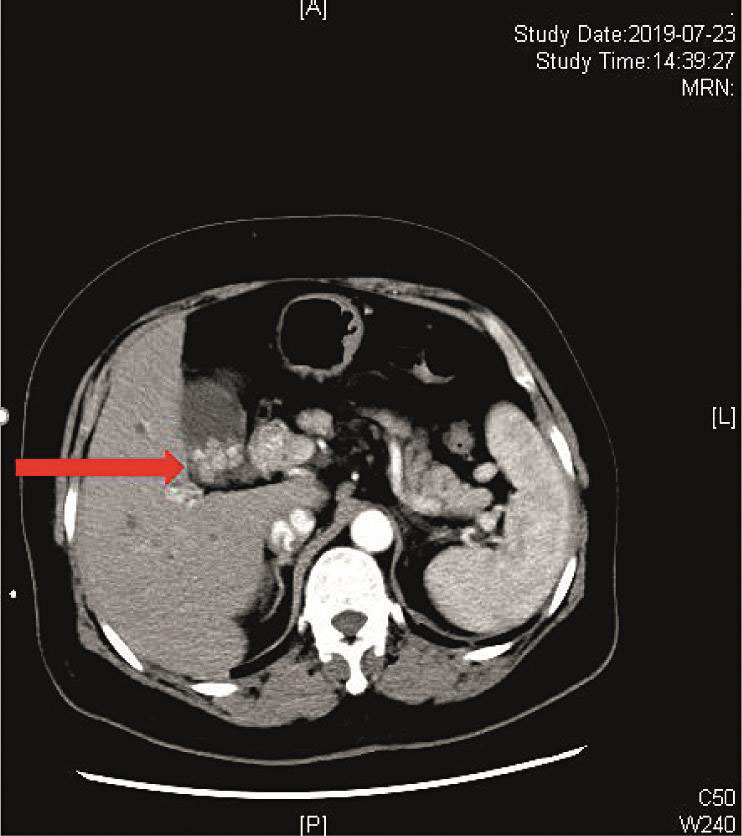 图2 箭头示胆囊及右肝管结石.jpg